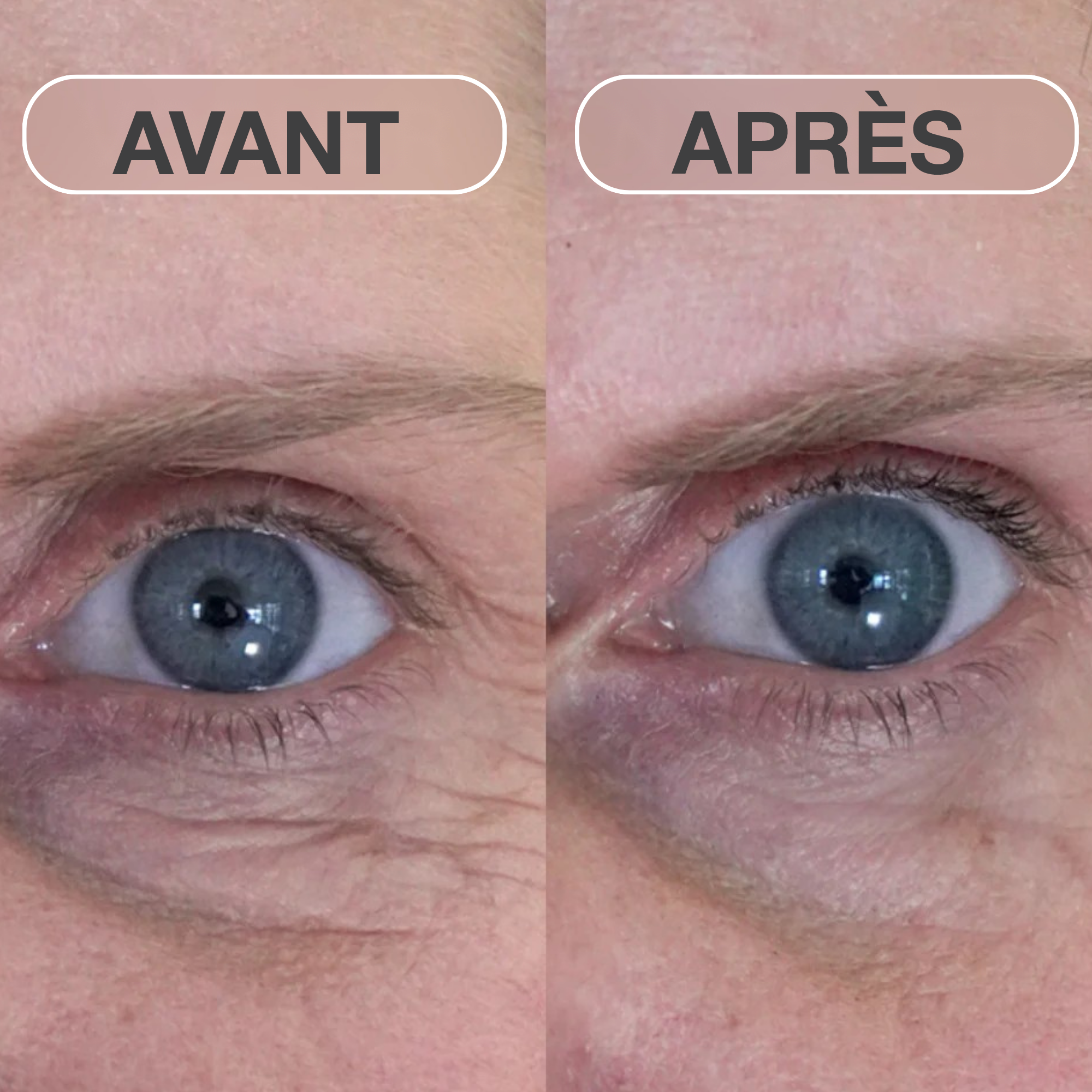 Patchs de micro-aiguillage à la botuline naturelle
