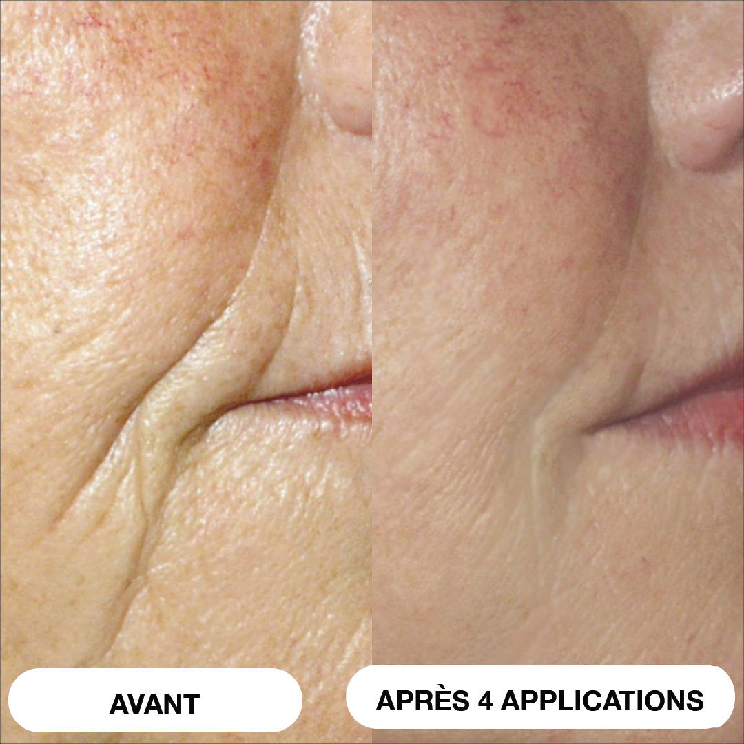 Système de micro-infusion Natural Botulin 8 semaines™