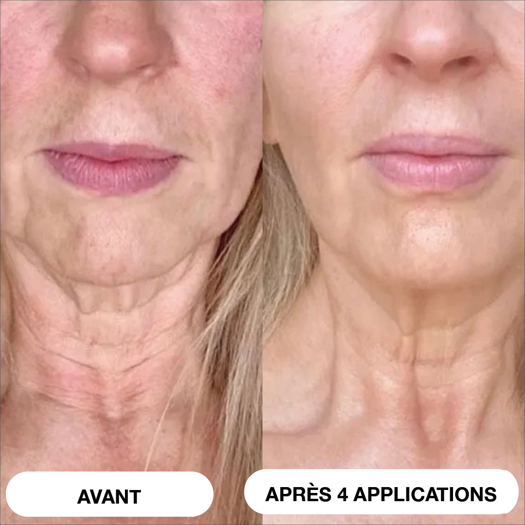Système de micro-infusion Natural Botulin 8 semaines™